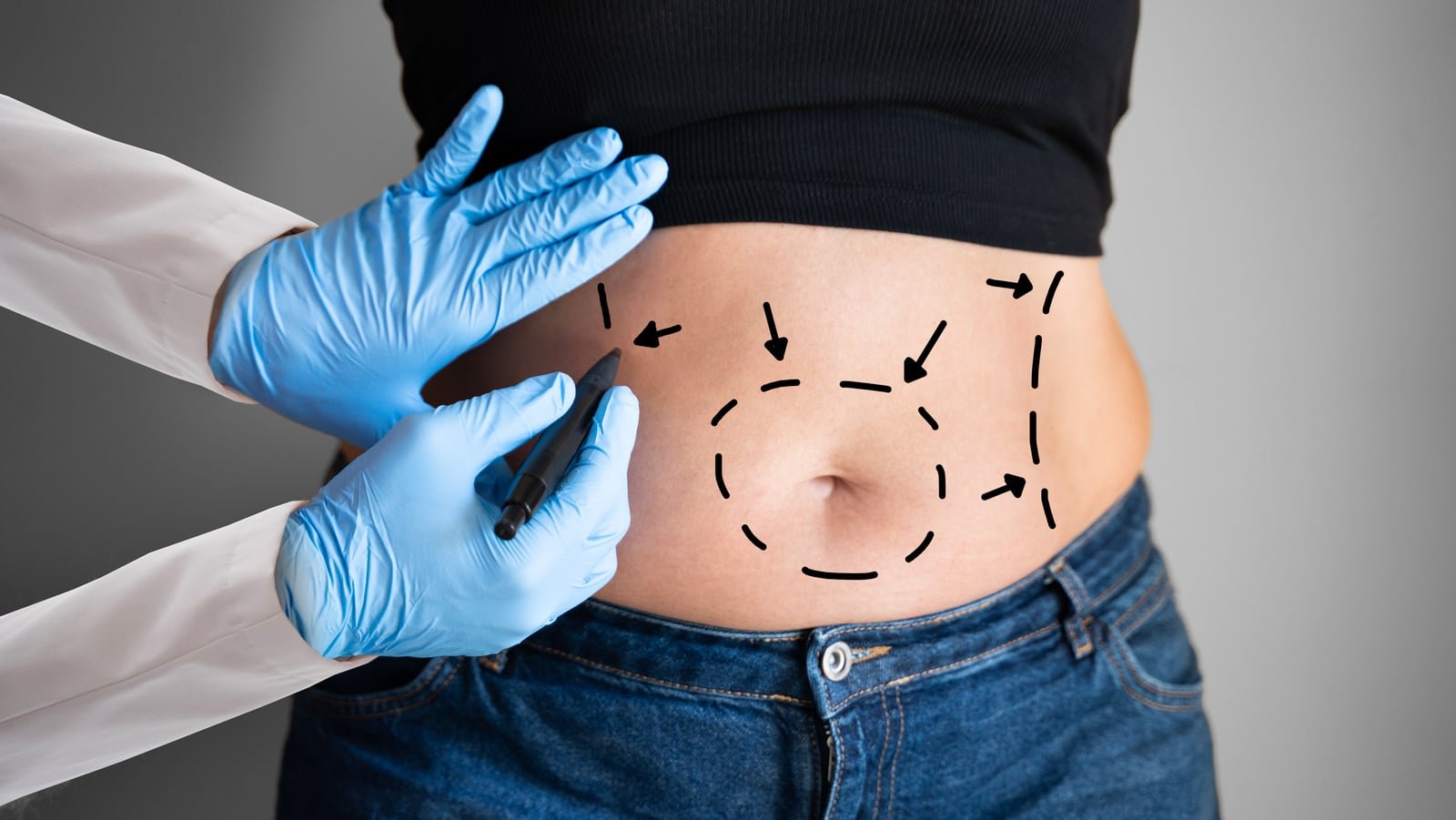 Les vêtements compressifs : un allié essentiel après une chirurgie esthétique